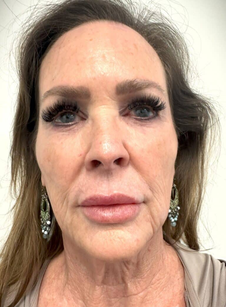 After Image: Full Face Botox & Filler - front