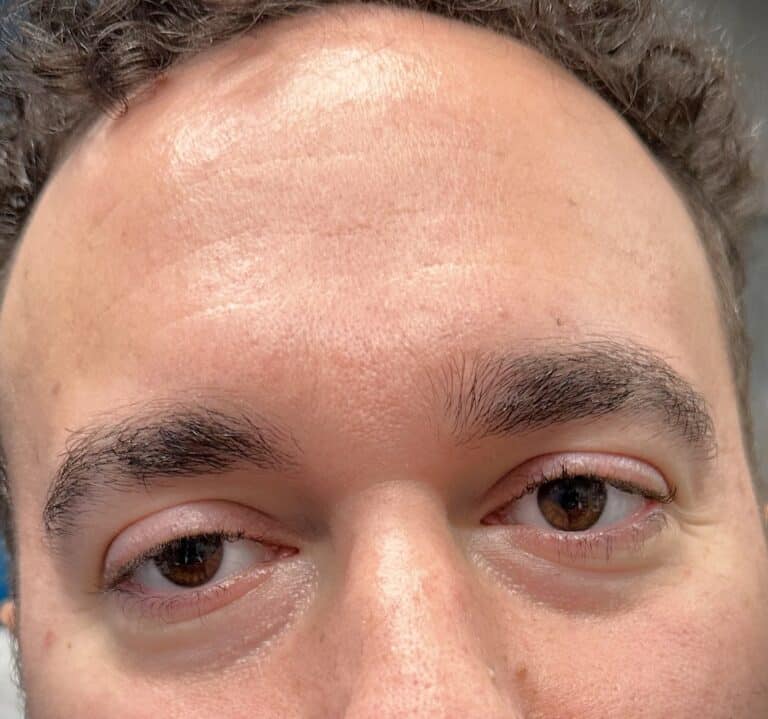 After Image: Male Botox - front