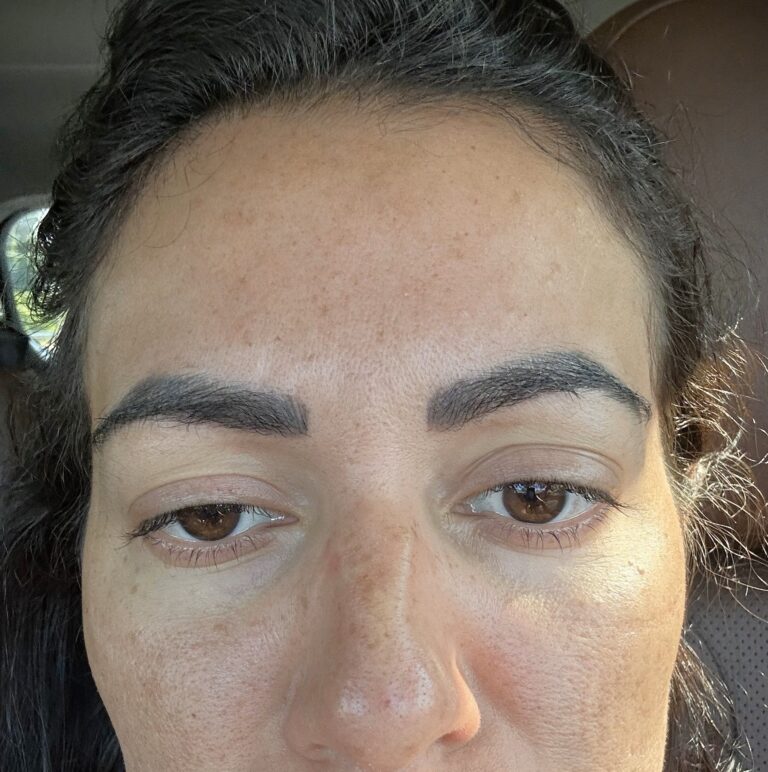 After Image: Glabella Botox - front