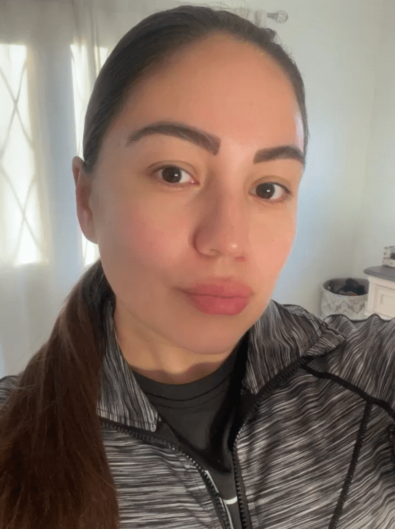 After Image: Full Face Botox - front