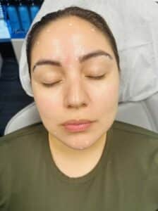 Before Image: Full Face Botox