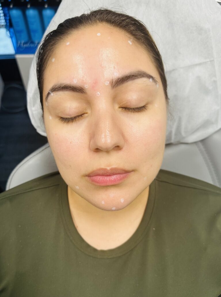 Before Image: Full Face Botox - front