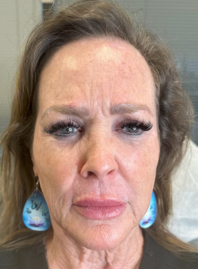 Before Image: Full Face Botox & Filler - front