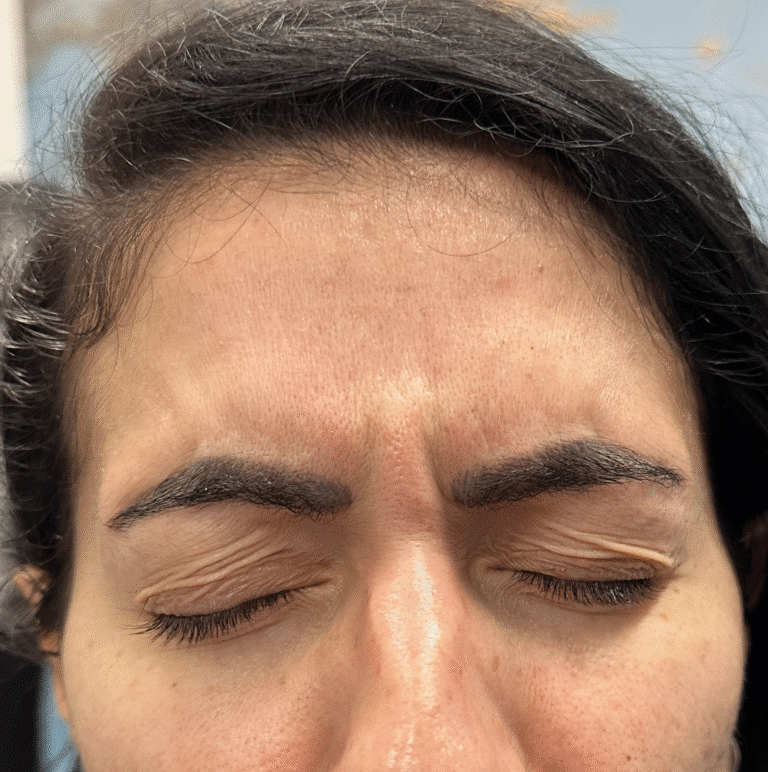 Before Image: Glabella Botox - front