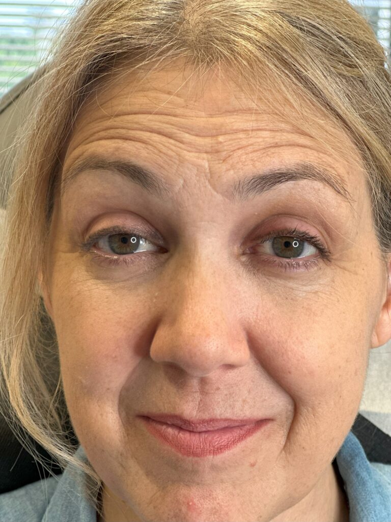 Before Image: Botox - front
