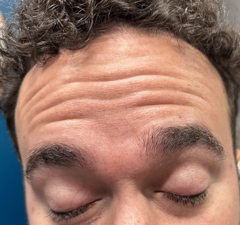 Before Image: Male Botox - front