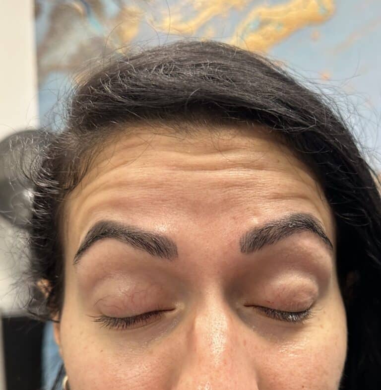 Before Image: Forehead lines - front