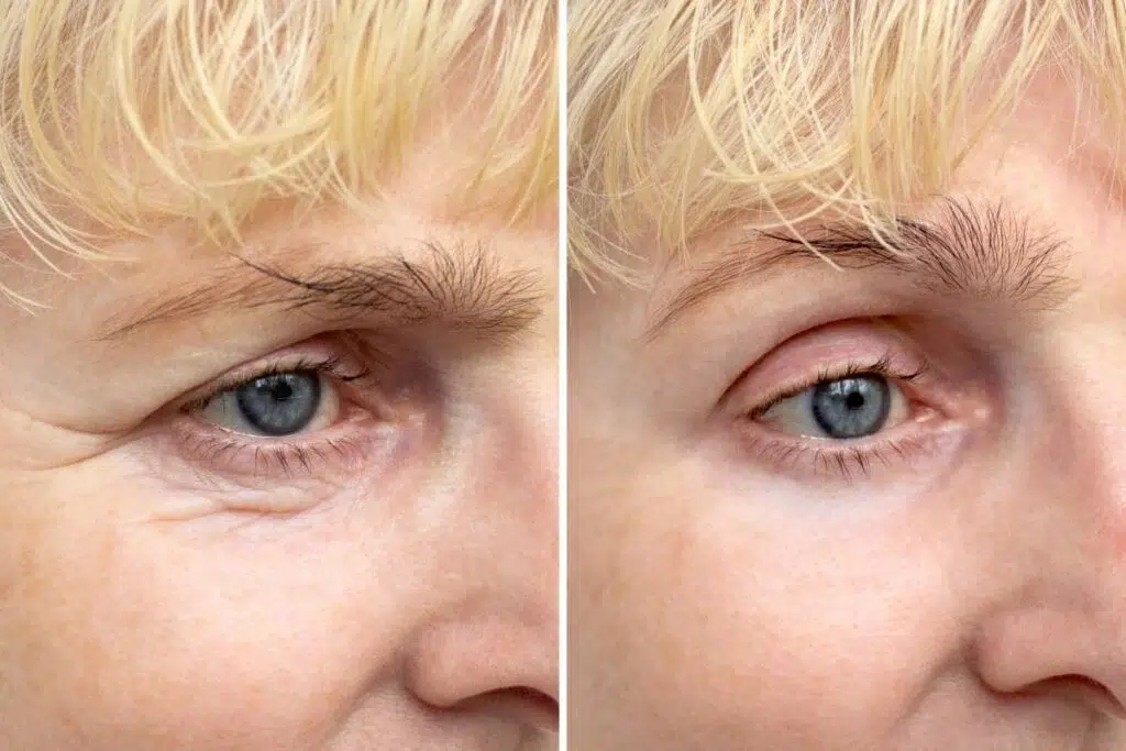 woman fights under eye wrinkles 1024x683
