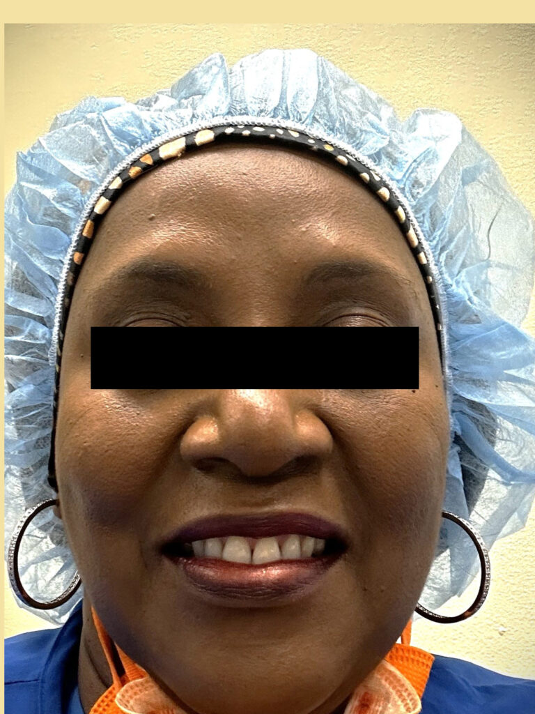 After Image: Botox - front