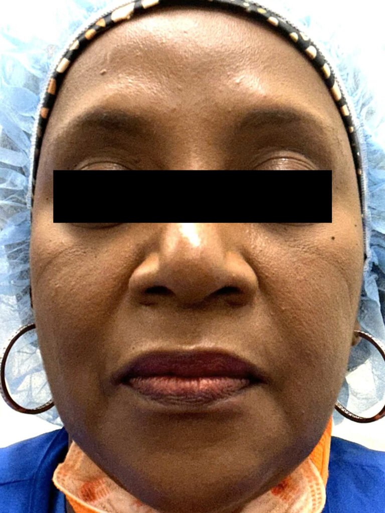 After Image: Botox - front