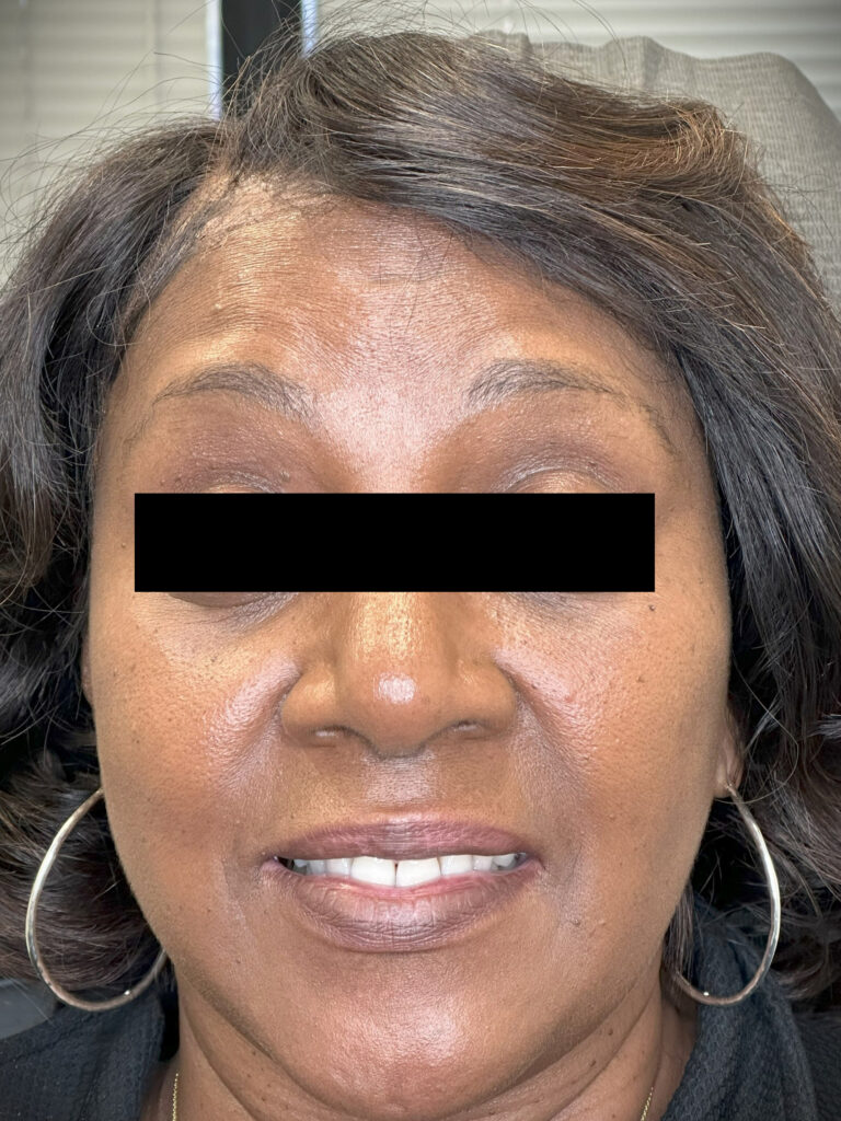 Before Image: Botox - front