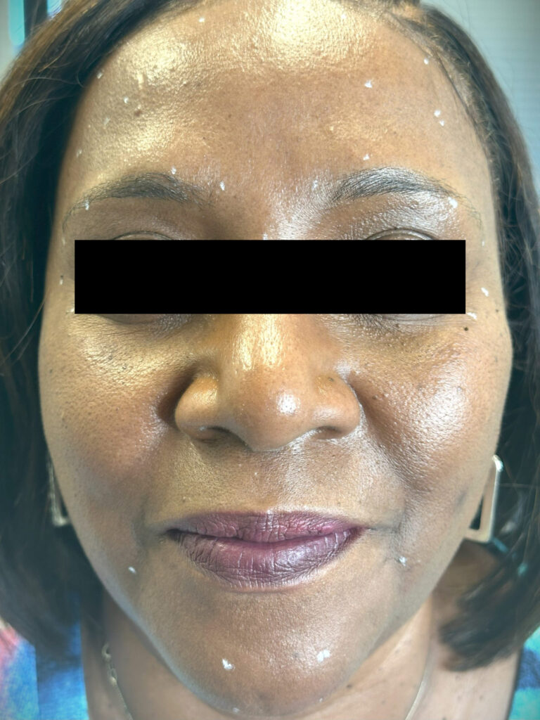 Before Image: Botox - front