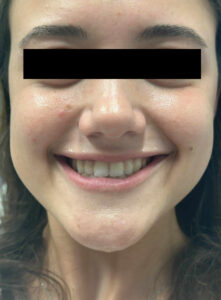 Before Image: Lip Flip