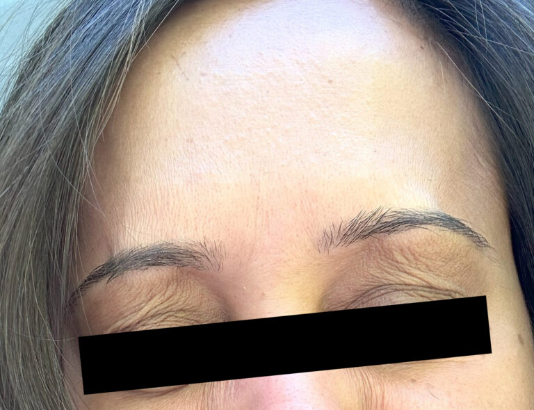 After Image: Glabella Botox - front