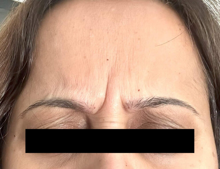 Before Image: Glabella Botox - front
