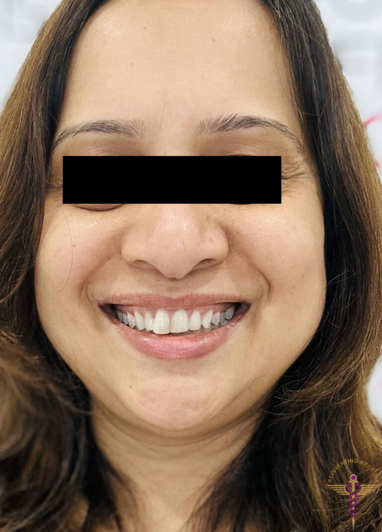 After Image: VI Peel - front