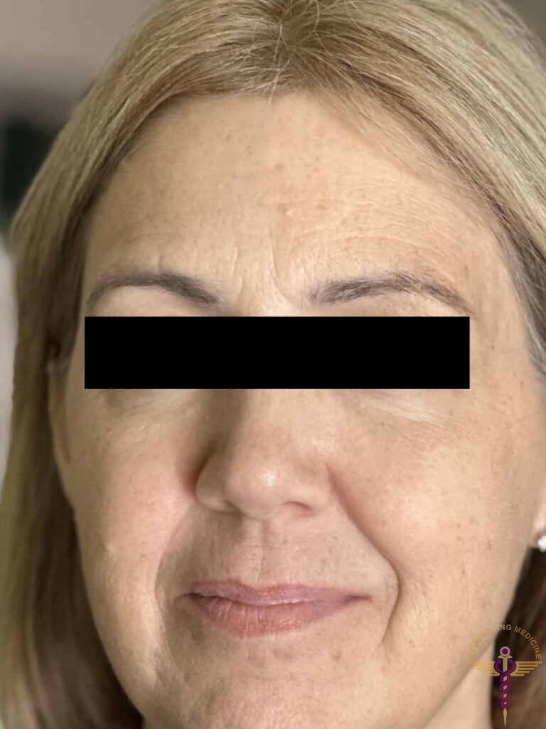 After Image: Botox - front