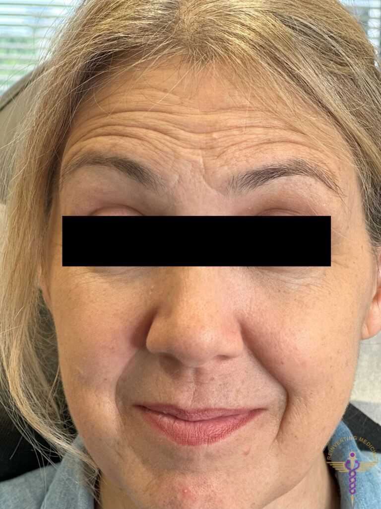 Before Image: Botox - front