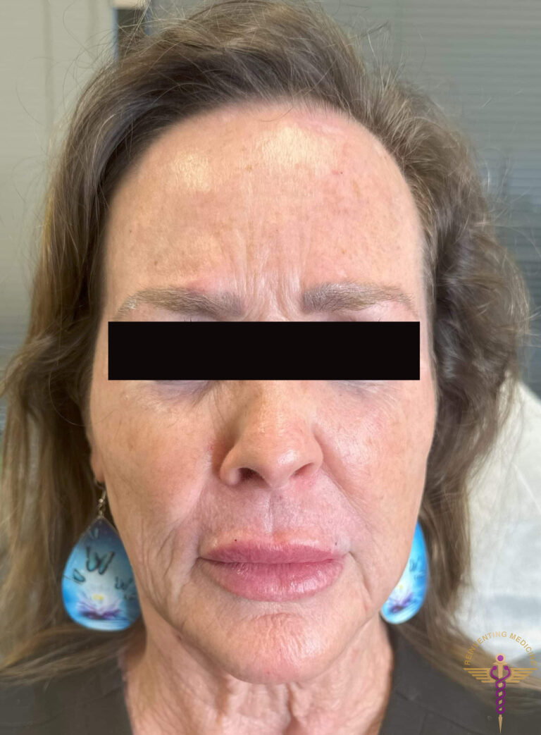 Before Image: Full Face Botox & Filler - front