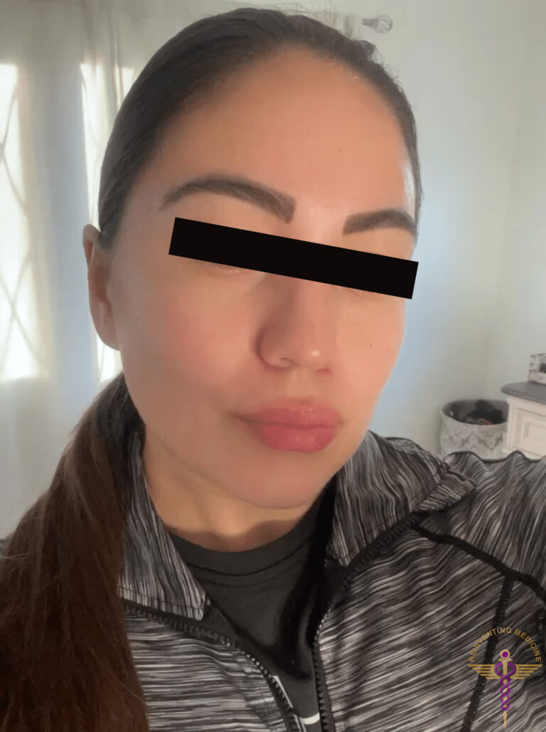After Image: Full Face Botox - front