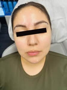 Before Image: Full Face Botox
