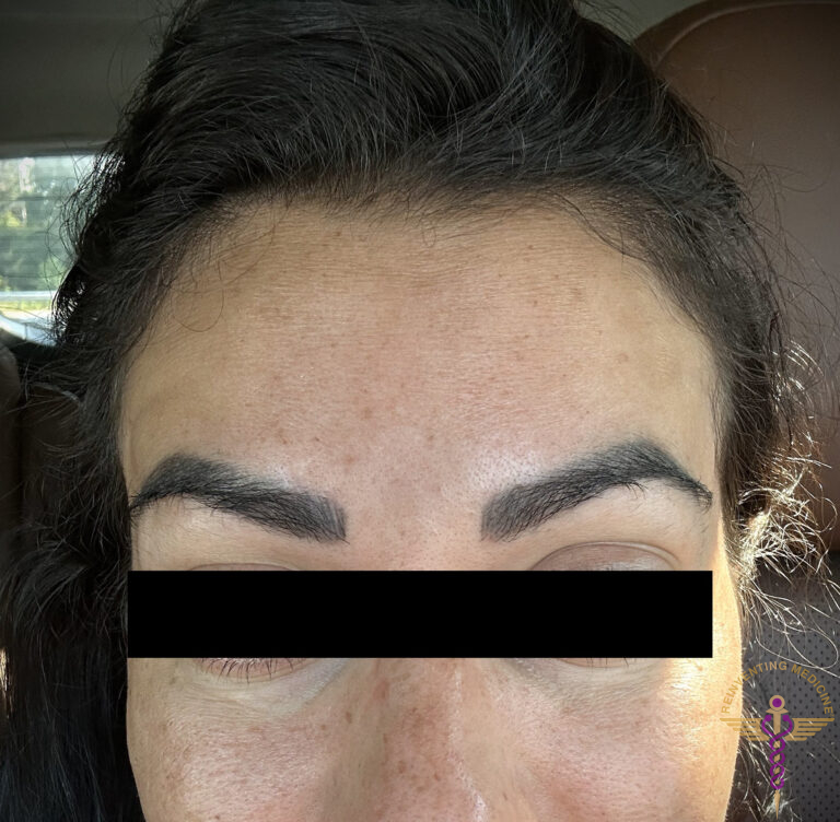 After Image: Forehead lines - front