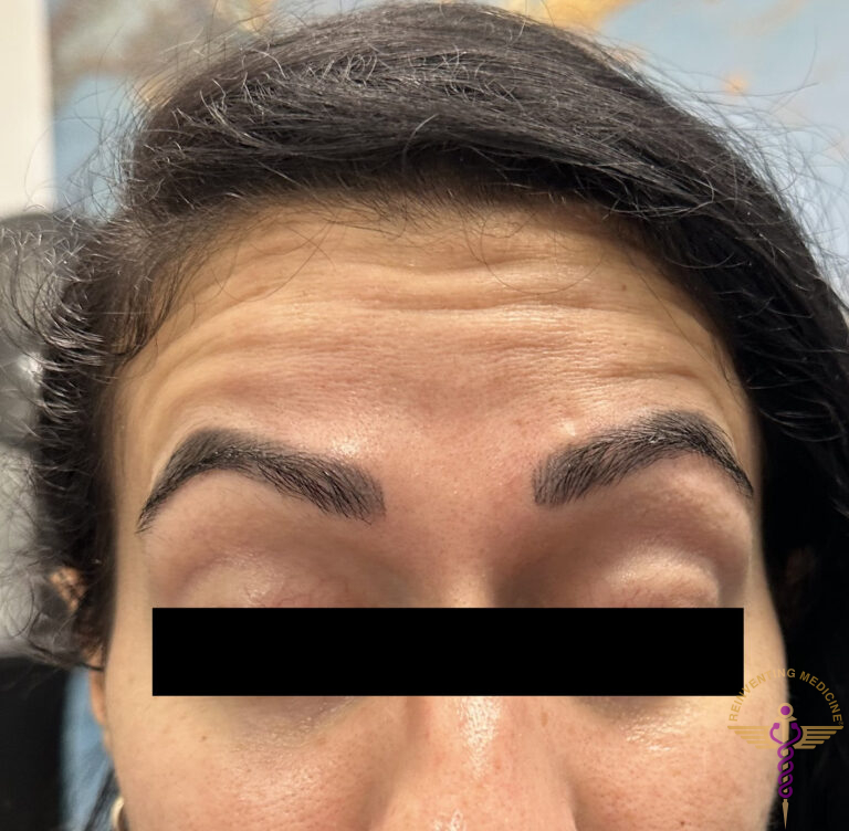 Before Image: Forehead lines - front