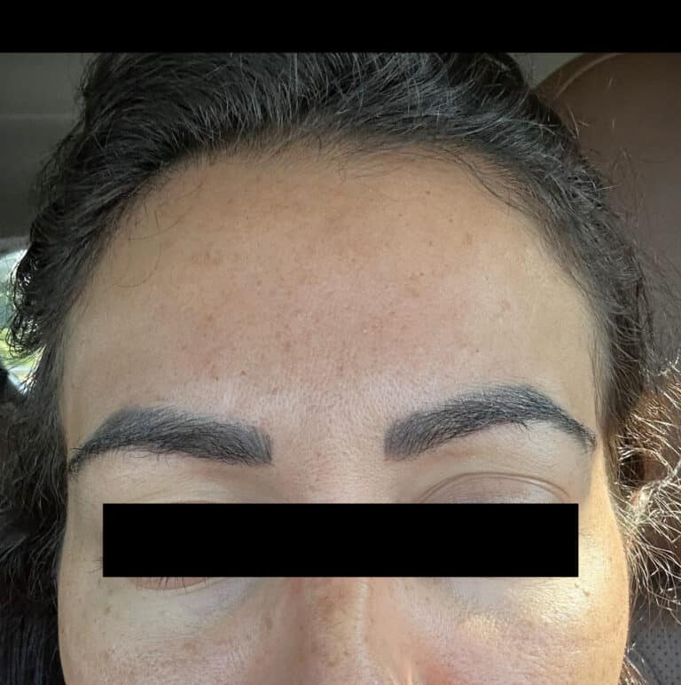 After Image: Glabella Botox - front