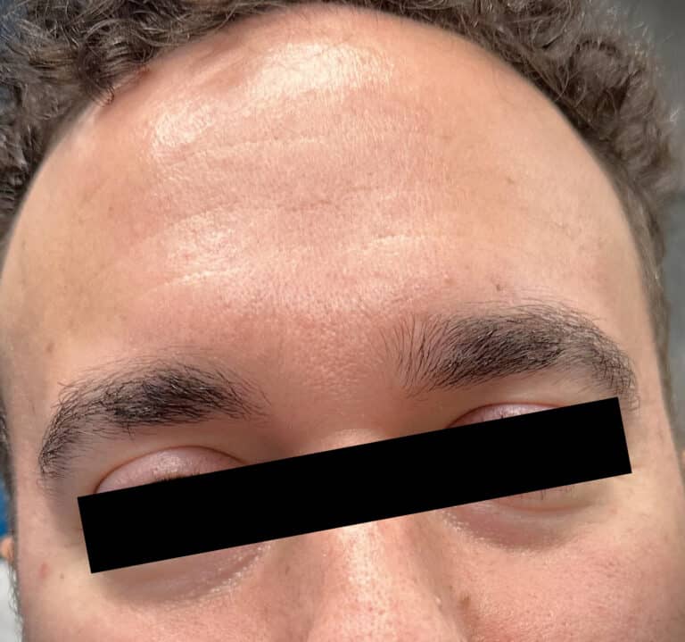 After Image: Male Botox - front