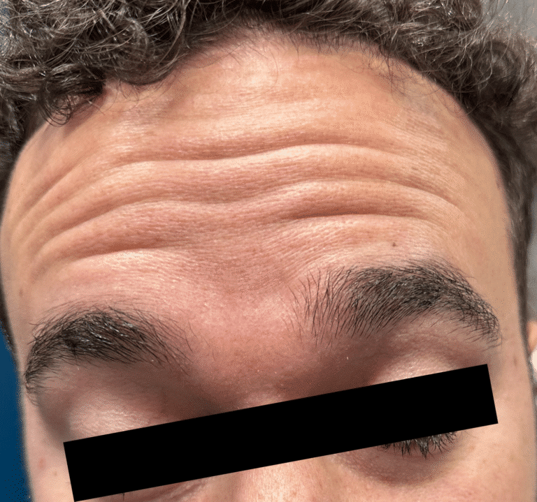 Before Image: Male Botox - front