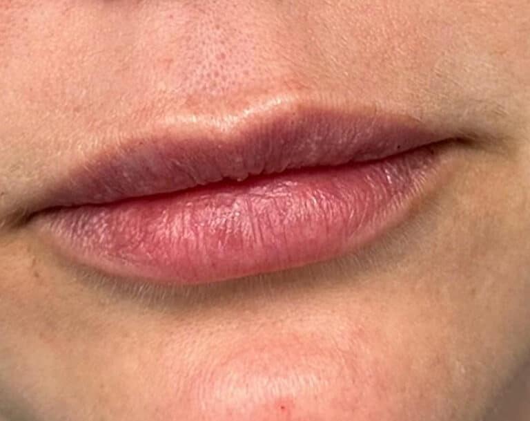 After Image: Lip Filler - front