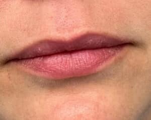 Before Image: Lip Filler