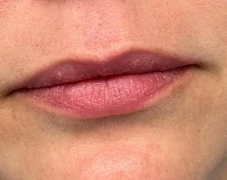 Before Image: Lip Filler - front