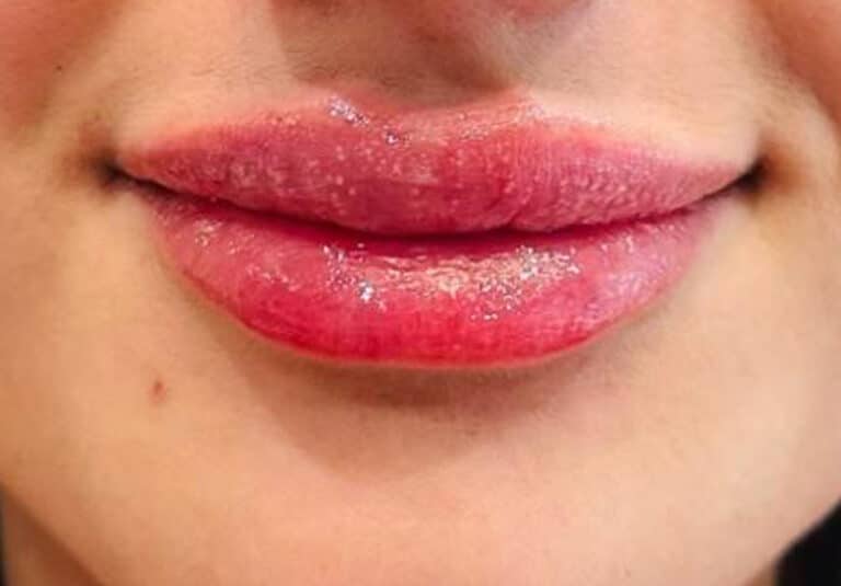 After Image: Lip Filler - front