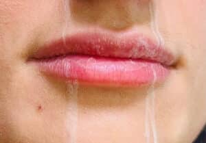 Before Image: Lip Filler